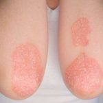 Mengenal Psoriasis dan Cara Mengobatinya