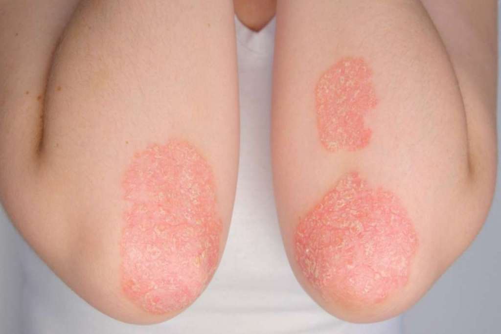 Mengenal Psoriasis dan Cara Mengobatinya